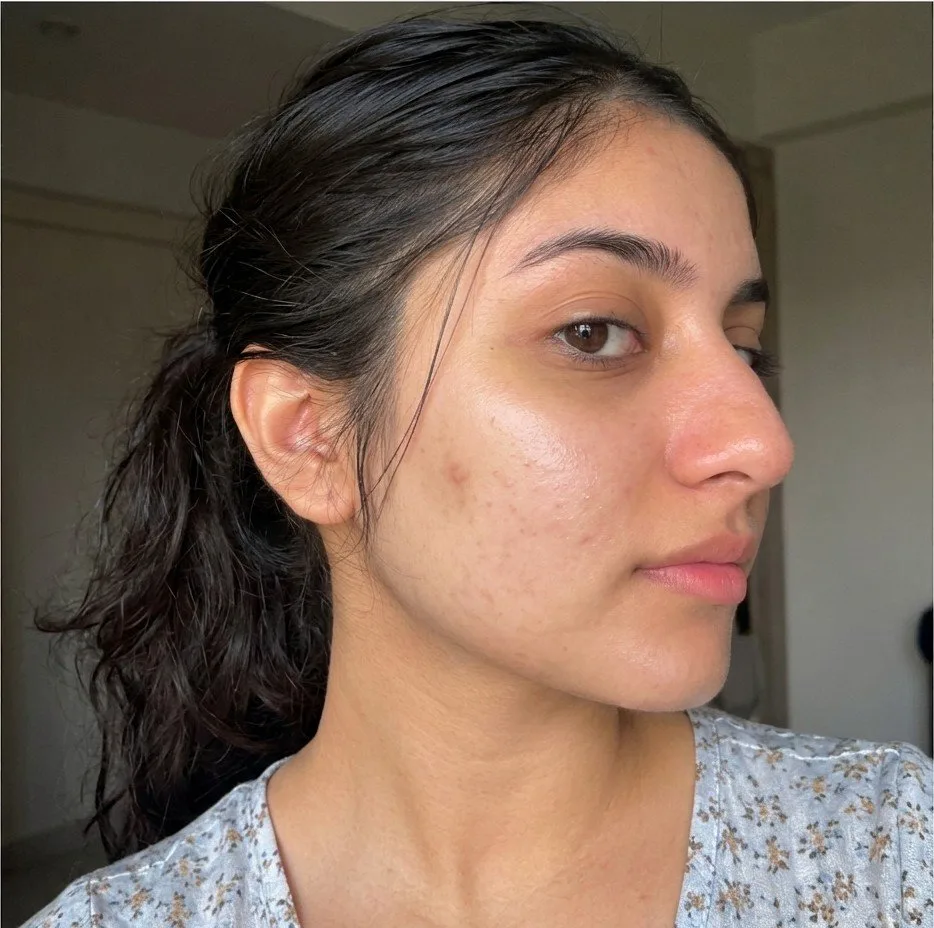 Customer skin after four weeks of using G&G Vitamin C Serum